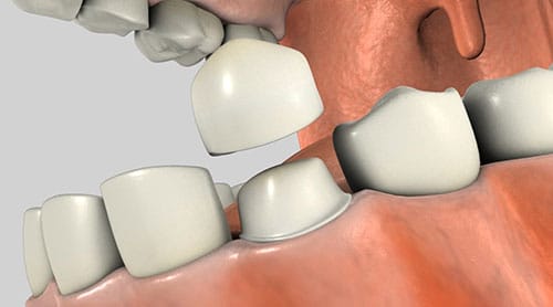 Dental Crowns