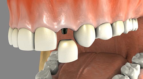 Dental Implants