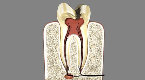 Root Canals