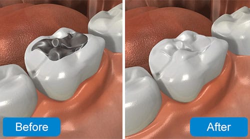Tooth Colored Fillings